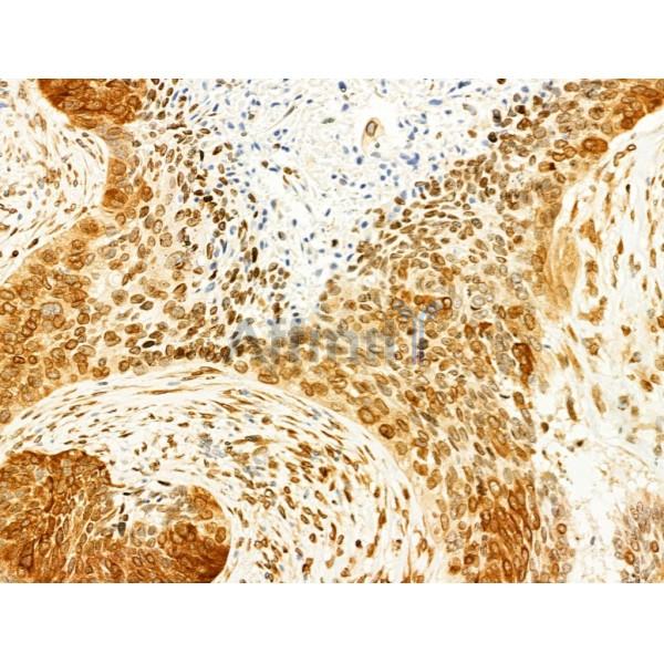Phospho-JNK1/2/3 (Thr183+Tyr185) Antibody - AF3318 at 1/100 staining Human lung cancer by IHC-P.
