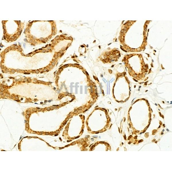 Phospho-JNK1/2/3 (Thr183+Tyr185) Antibody - AF3318 at 1/100 staining Human mammary cancer by IHC-P.