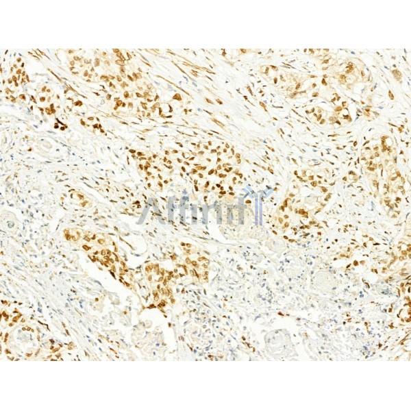 Phospho-JNK1/2/3 (Thr183+Tyr185) Antibody - AF3318 at 1/100 staining Human esophageal cancer by IHC-P.