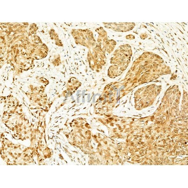 Phospho-JNK1/2/3 (Thr183+Tyr185) Antibody - AF3318 at 1/100 staining Human esophageal cancer by IHC-P.