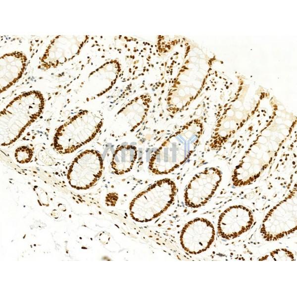 Phospho-FAK (Tyr397) Antibody - AF3398 at 1/100 staining Human normal tissues adjacent to colorectal cancer by IHC-P.