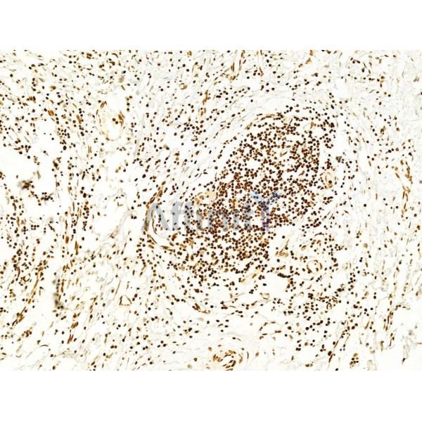 Phospho-FAK (Tyr397) Antibody - AF3398 at 1/100 staining Human colorectal cancer by IHC-P.