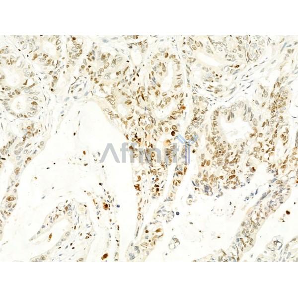 Phospho-FAK (Tyr397) Antibody - AF3398 at 1/100 staining Human colorectal cancer by IHC-P.