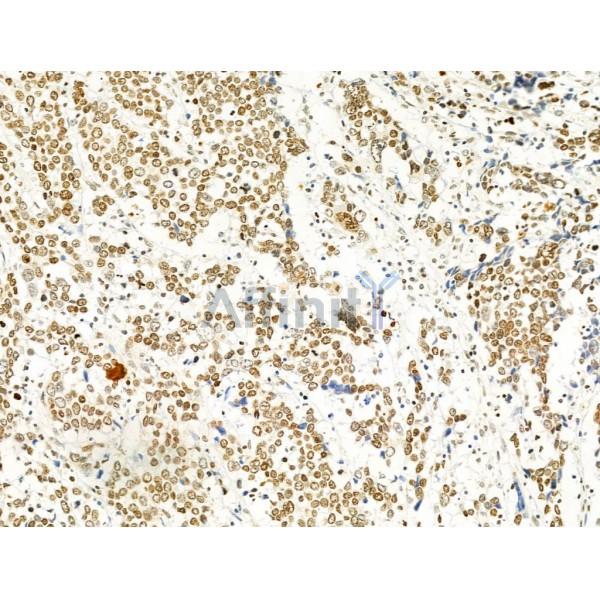 Phospho-FAK (Tyr397) Antibody - AF3398 at 1/100 staining Human gastric cancer by IHC-P.