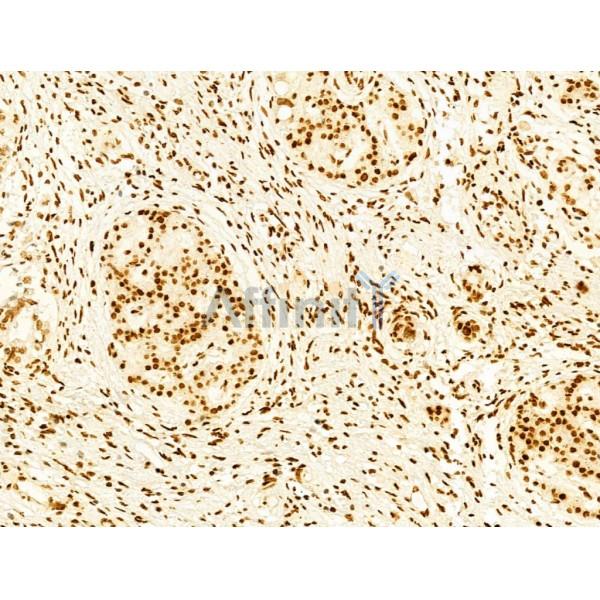 Phospho-FAK (Tyr397) Antibody - AF3398 at 1/100 staining Human pancreatic cancer by IHC-P.