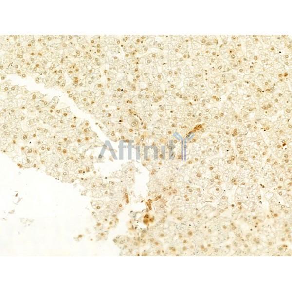 Phospho-FAK (Tyr397) Antibody - AF3398 at 1/100 staining Human liver cancer by IHC-P.