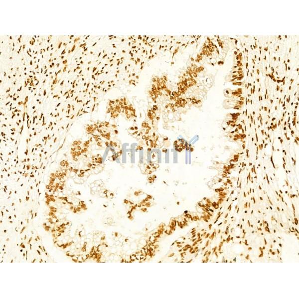 Phospho-FAK (Tyr397) Antibody - AF3398 at 1/100 staining Human pancreatic cancer by IHC-P.