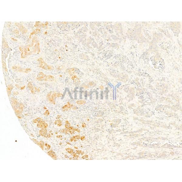 IL1 beta Antibody - AF5103 at 1/100 staining Human mammary cancer by IHC-P.