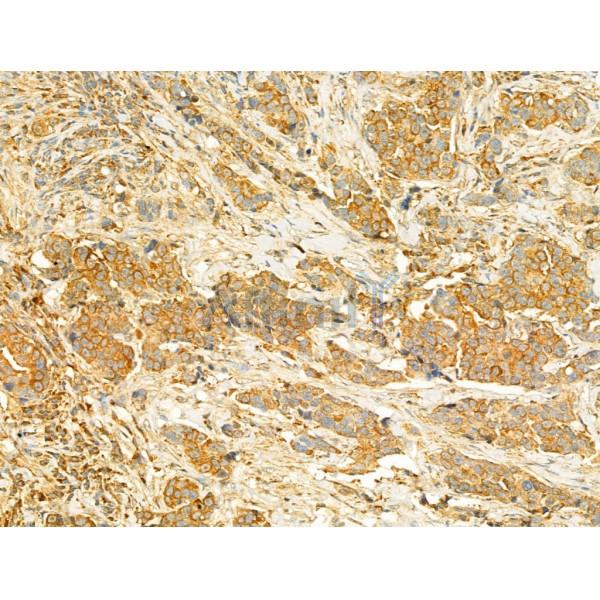 PI3 kinase P110 alpha Antibody - AF5112 at 1/100 staining Human mammary cancer by IHC-P.