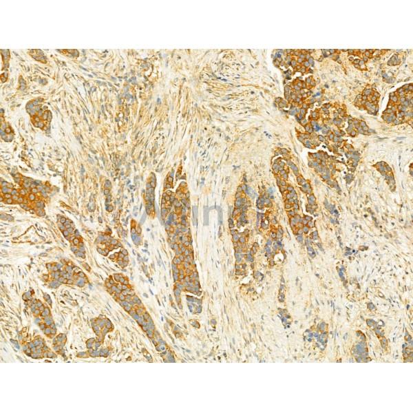 PI3 kinase P110 alpha Antibody - AF5112 at 1/100 staining Human mammary cancer by IHC-P.