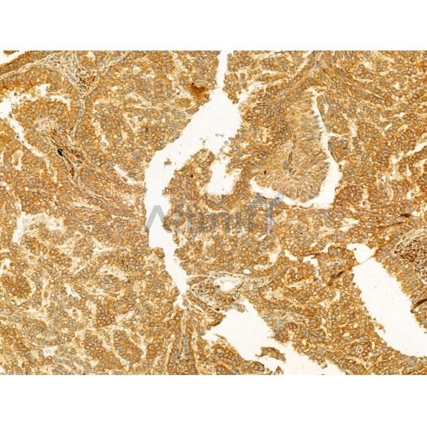 PI3 kinase P110 alpha Antibody - AF5112 at 1/100 staining Human lung cancer by IHC-P.