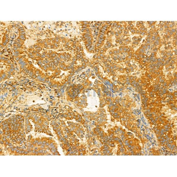 PI3 kinase P110 alpha Antibody - AF5112 at 1/100 staining Human lung cancer by IHC-P.