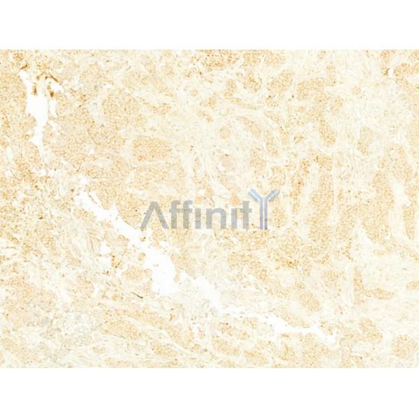 Beclin 1 Antibody - AF5128 at 1/100 staining Human mammary cancer by IHC-P.
