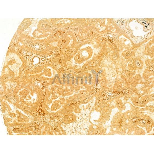 VEGFA Antibody - AF5131 at 1/100 staining Human lung cancer by IHC-P.