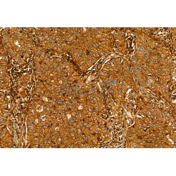MMP9 Antibody - AF5228 at 1/100 staining Human lung cancer by IHC-P.