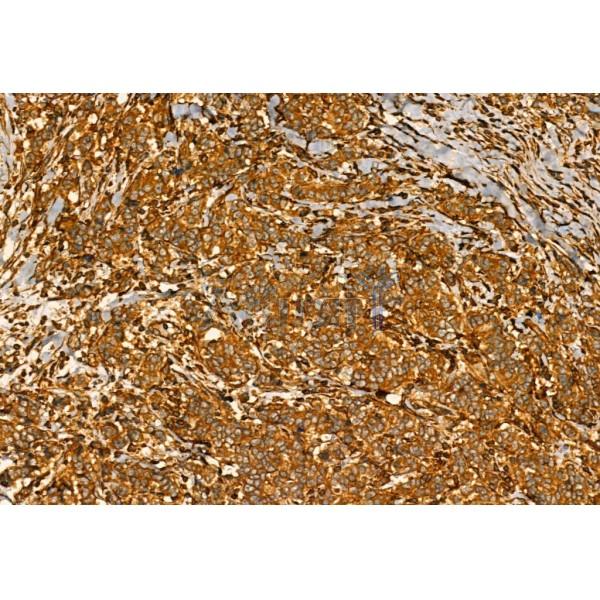 MMP9 Antibody - AF5228 at 1/100 staining Human mammary cancer by IHC-P.