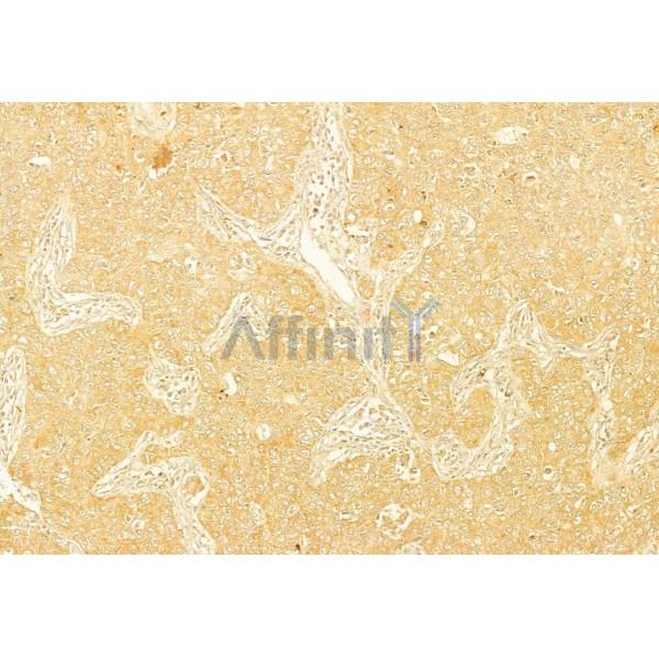 PERK Antibody - AF5304 at 1/100 staining Human lung cancer by IHC-P.