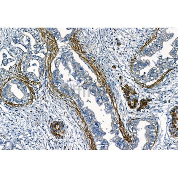 MMP2 Antibody - AF5330 at 1/100 staining Human normal tissues adjacent to esophageal cancer by IHC-P.