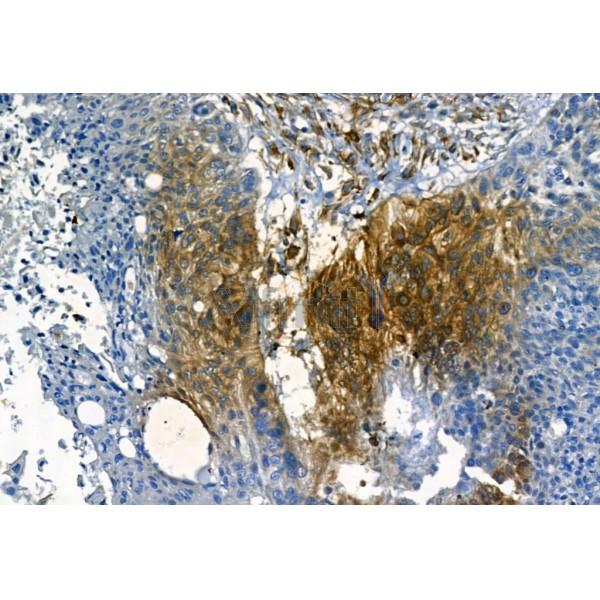 MMP2 Antibody - AF5330 at 1/100 staining Human lung cancer by IHC-P.