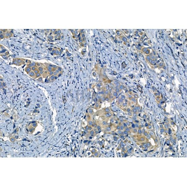MMP2 Antibody - AF5330 at 1/100 staining Human mammary cancer by IHC-P.
