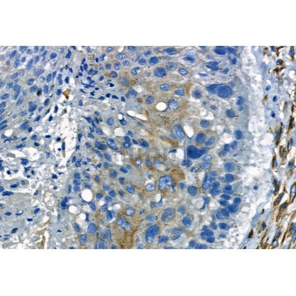 MMP2 Antibody - AF5330 at 1/100 staining Human lung cancer by IHC-P.