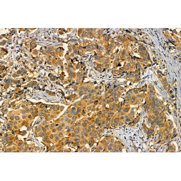 SQSTM1/p62 Antibody - AF5384 at 1/100 staining Human mammary cancer by IHC-P.