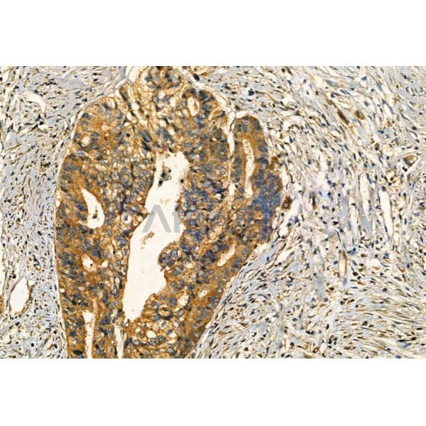 SQSTM1/p62 Antibody - AF5384 at 1/100 staining Human colorectal cancer by IHC-P.