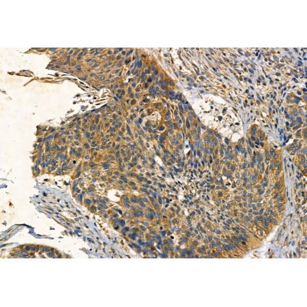SQSTM1/p62 Antibody - AF5384 at 1/100 staining Human lung cancer by IHC-P.