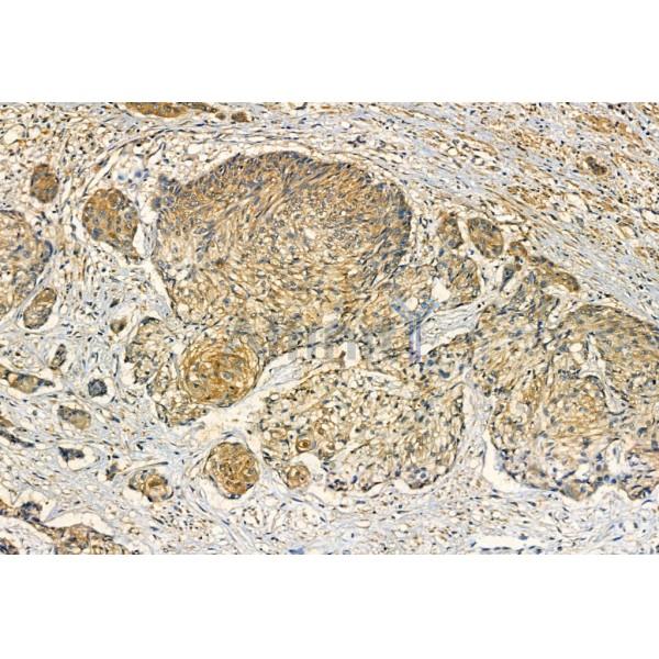 SQSTM1/p62 Antibody - AF5384 at 1/100 staining Human normal tissues adjacent to esophageal cancer by IHC-P.