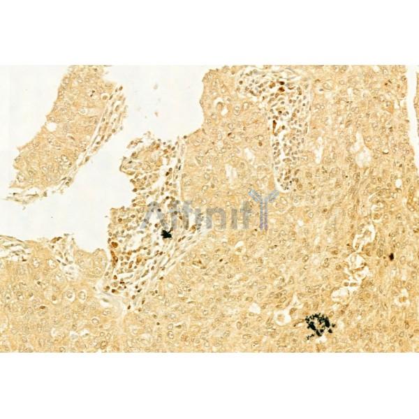 LC3A/B Antibody - AF5402 at 1/100 staining Human lung cancer by IHC-P.