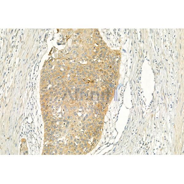 EGFR Antibody - AF6043 at 1/100 staining Human esophageal cancer by IHC-P.