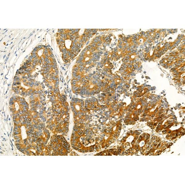 EGFR Antibody - AF6043 at 1/100 staining Human colorectal cancer by IHC-P.
