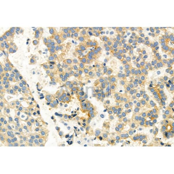 EGFR Antibody - AF6043 at 1/100 staining Human lung cancer by IHC-P.