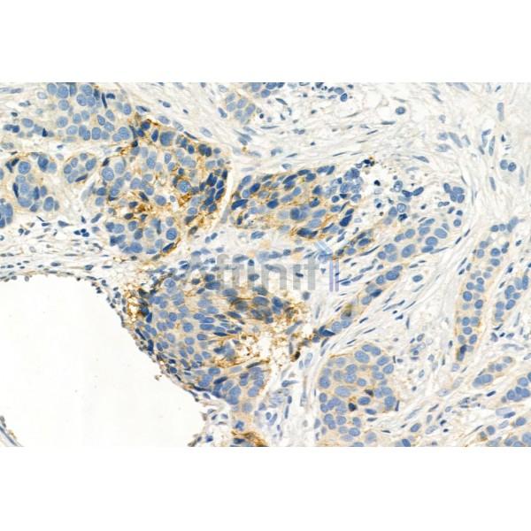 EGFR Antibody - AF6043 at 1/100 staining Human mammary cancer by IHC-P.