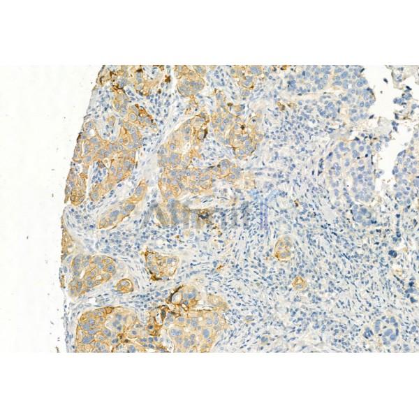 EGFR Antibody - AF6043 at 1/100 staining Human mammary cancer by IHC-P.