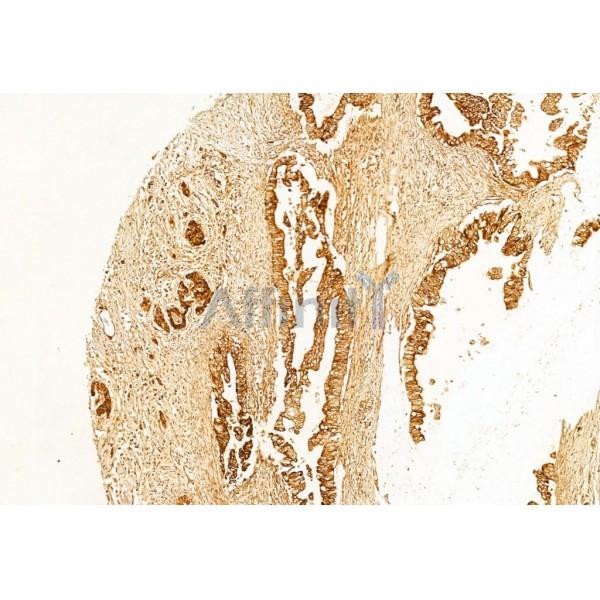 Bcl-2 Antibody - AF6139 at 1/100 staining Human pancreatic cancer by IHC-P.