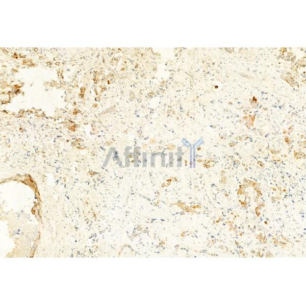PI3K p85 alpha Antibody - AF6241 at 1/100 staining Human mammary cancer by IHC-P.