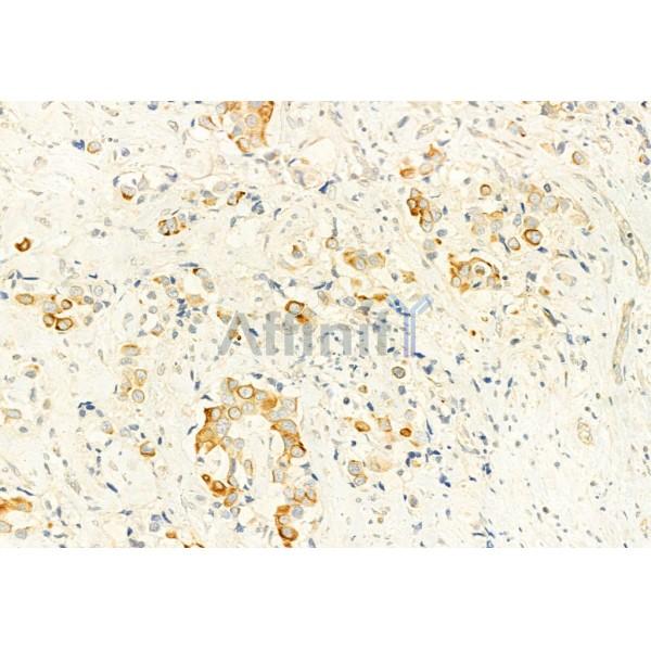 PI3K p85 alpha Antibody - AF6241 at 1/100 staining Human mammary cancer by IHC-P.