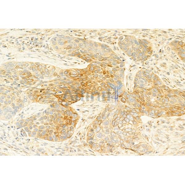PI3K p85 alpha Antibody - AF6241 at 1/100 staining Human lung cancer by IHC-P.