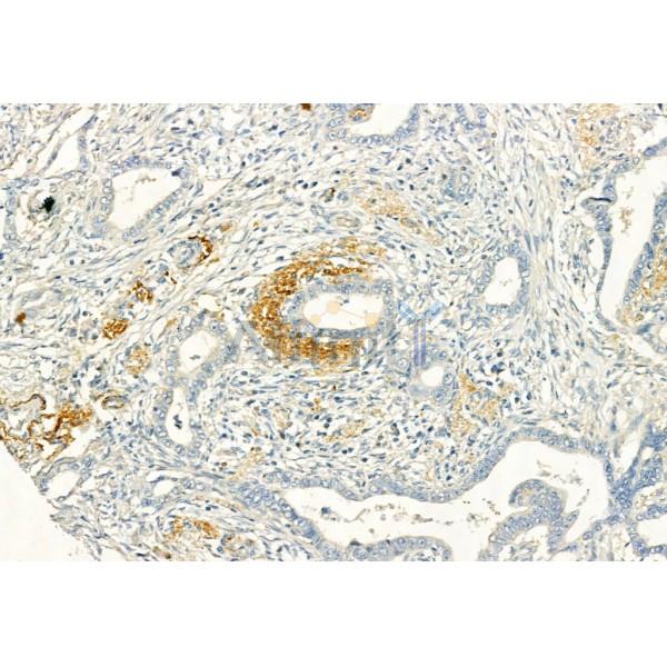 Caspase 9 Antibody - AF6348 at 1/100 staining Human pancreatic cancer by IHC-P.