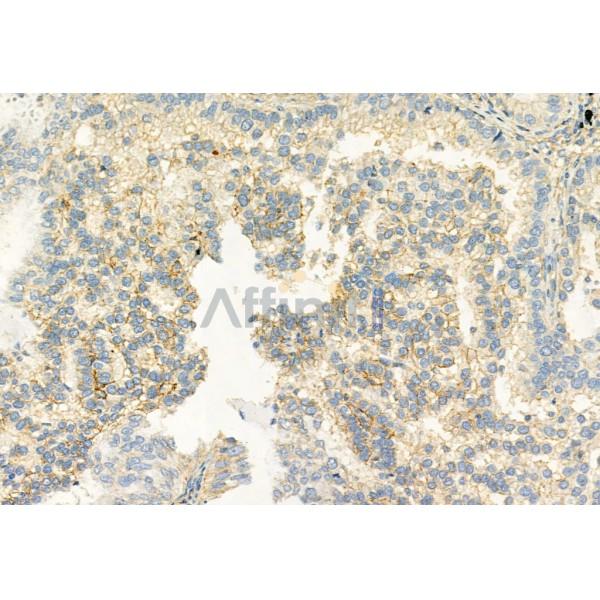 Caspase 9 Antibody - AF6348 at 1/100 staining Human lung cancer by IHC-P.