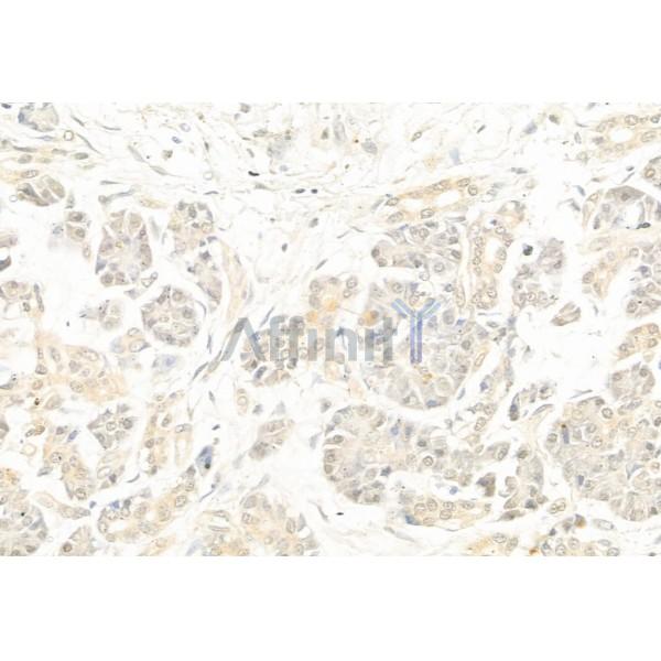 PTEN Antibody - AF6351 at 1/100 staining Human pancreatic cancer by IHC-P.