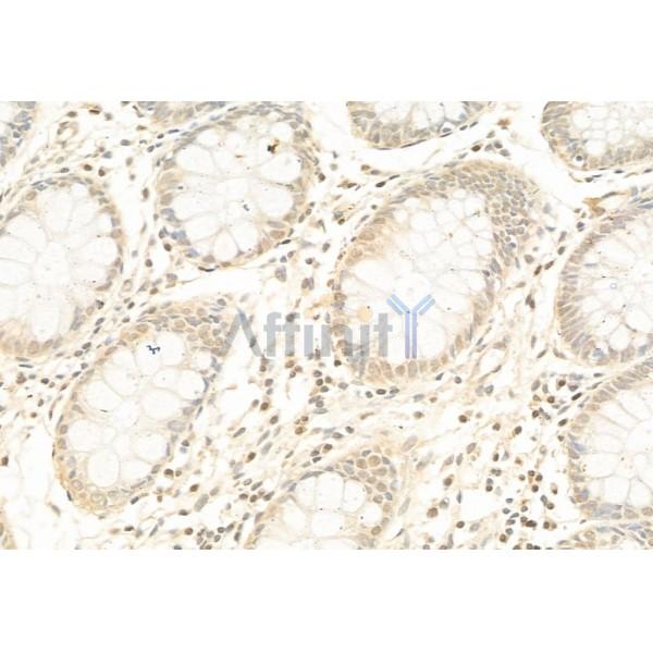 PTEN Antibody - AF6351 at 1/100 staining Human gastric cancer by IHC-P.