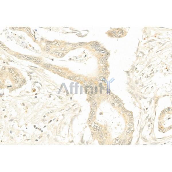 PTEN Antibody - AF6351 at 1/100 staining Human pancreatic cancer by IHC-P.
