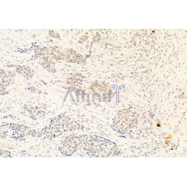 Smad2 Antibody - AF6449 at 1/100 staining Human mammary cancer by IHC-P.