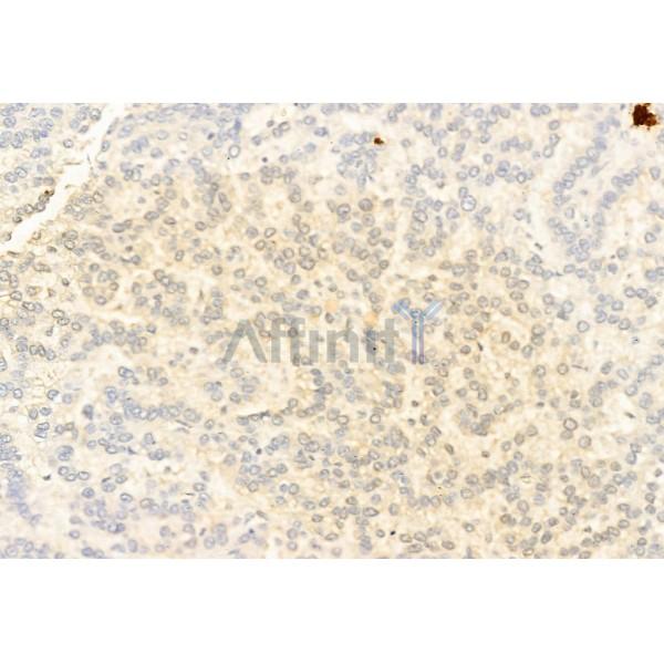 Smad2 Antibody - AF6449 at 1/100 staining Human lung cancer by IHC-P.
