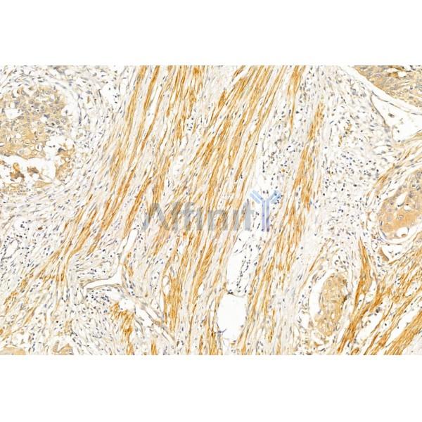 Collagen I Antibody - AF7001 at 1/100 staining Human esophageal cancer by IHC-P.