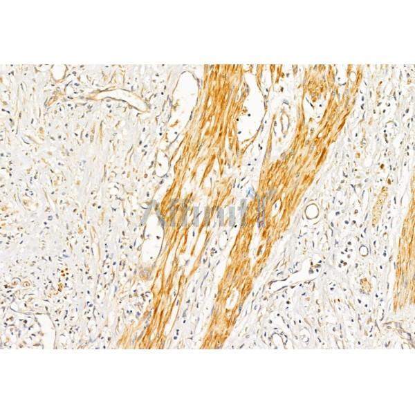 Collagen I Antibody - AF7001 at 1/100 staining Human esophageal cancer by IHC-P.