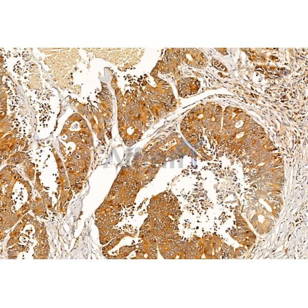 TNF alpha Antibody - AF7014 at 1/100 staining Human colorectal cancer by IHC-P.