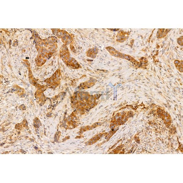 TNF alpha Antibody - AF7014 at 1/100 staining Human mammary cancer by IHC-P.